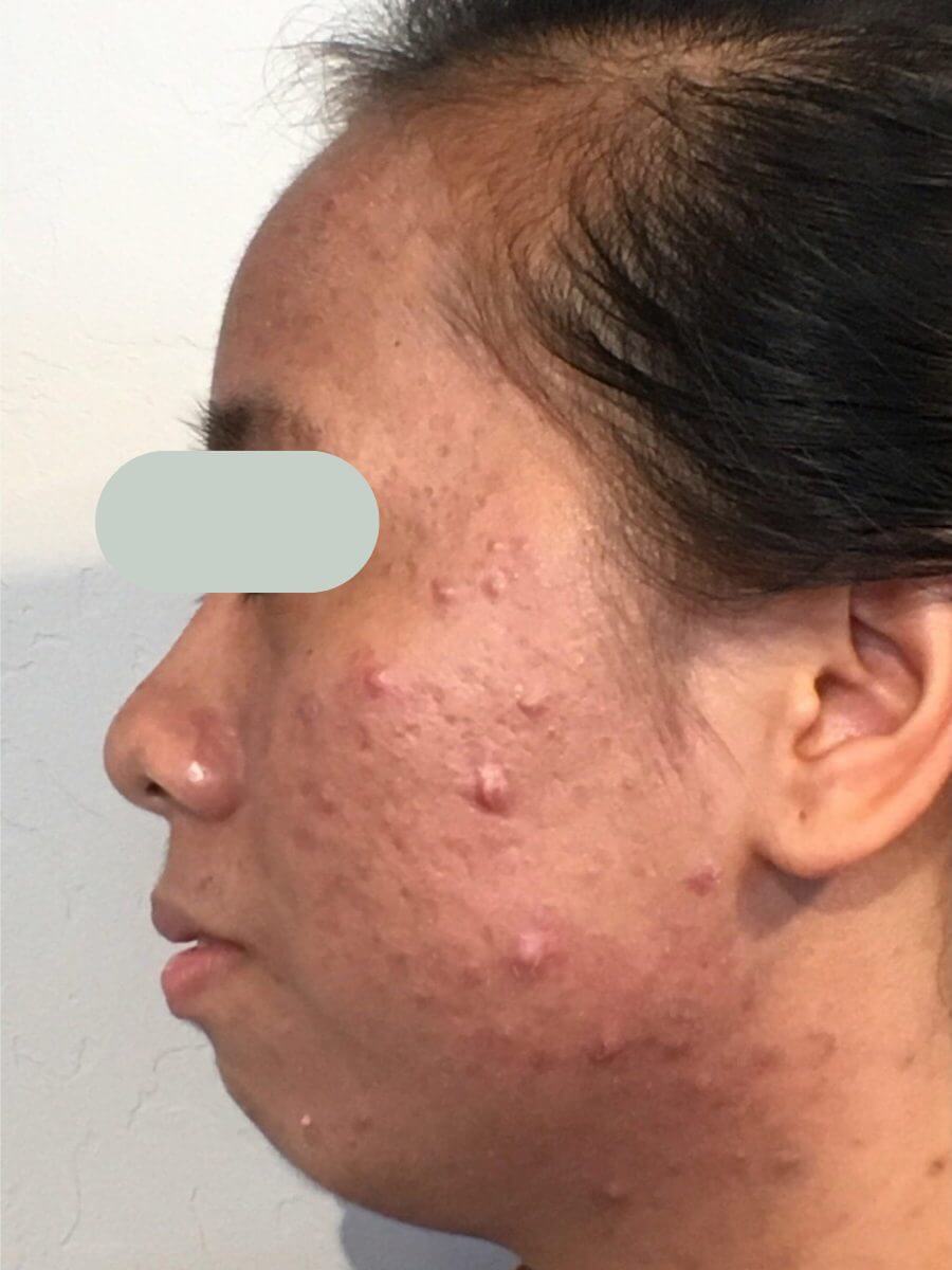 patient with acne treated by dr. menezes