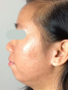 patient with crows feet wrinkles treated by Dr. menezes