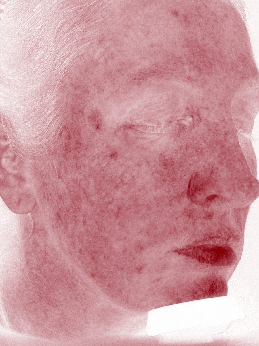 facial redness analysis after IPL treatment