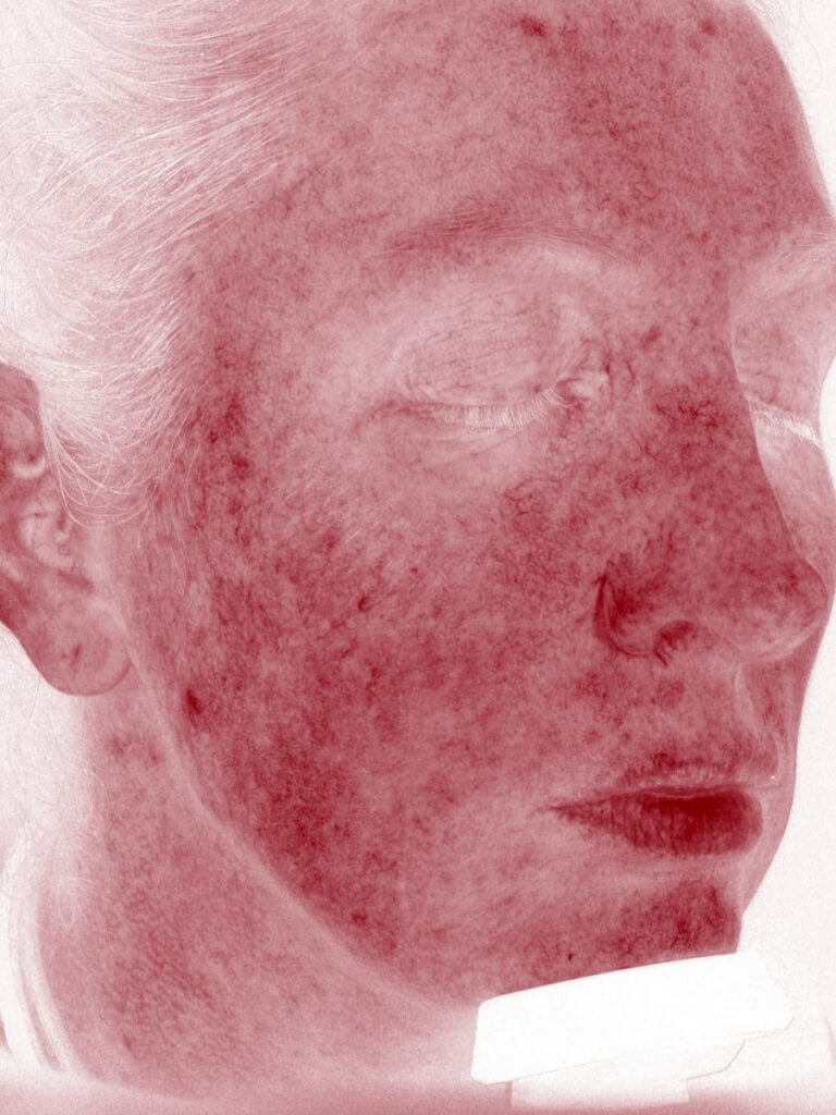 facial redness analysis before IPL treatment