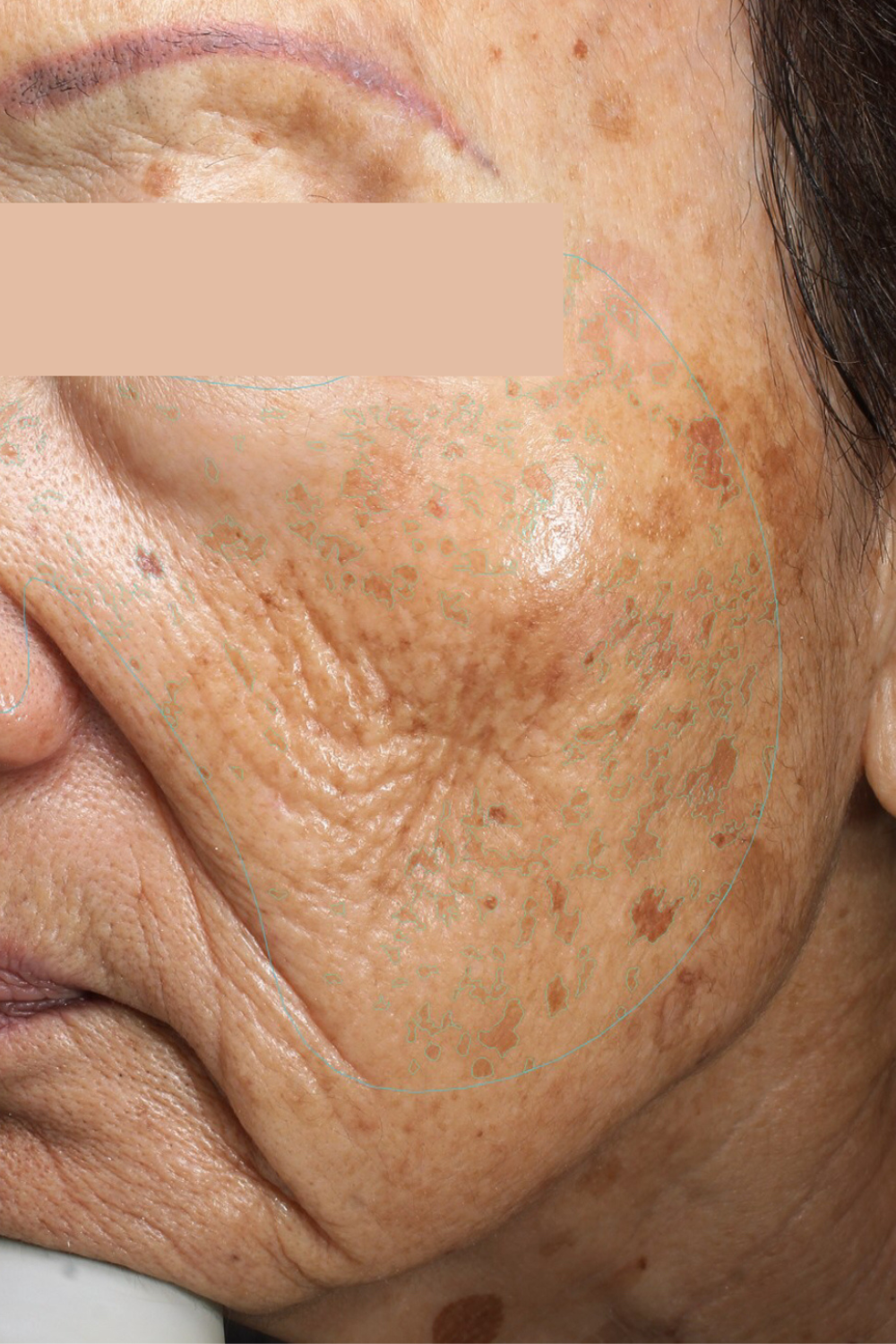 melinda menezes md aesthetic medical results. real patient. results may vary. Image shows wrinkles and skin discoloration