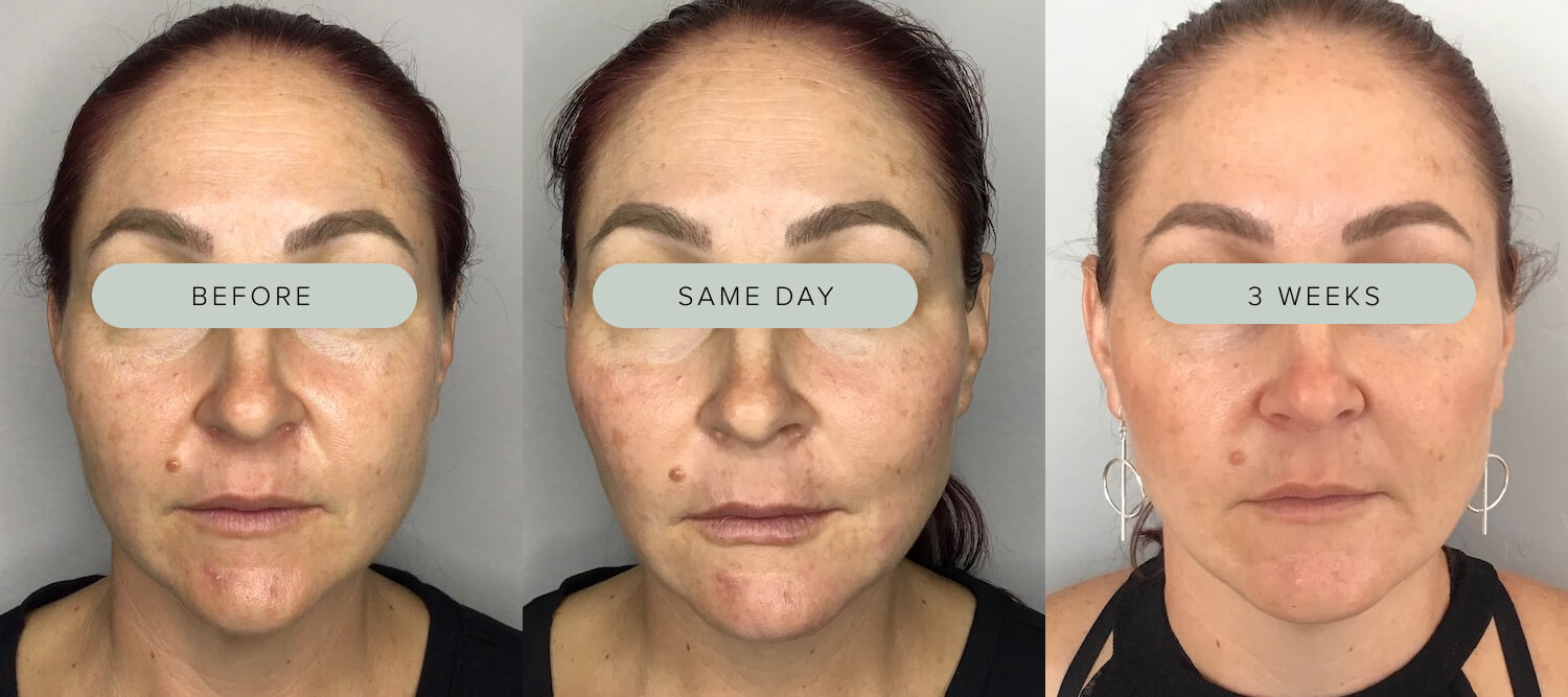 Patient Melinda Menezes - Results for aging, volume loss, and sagging