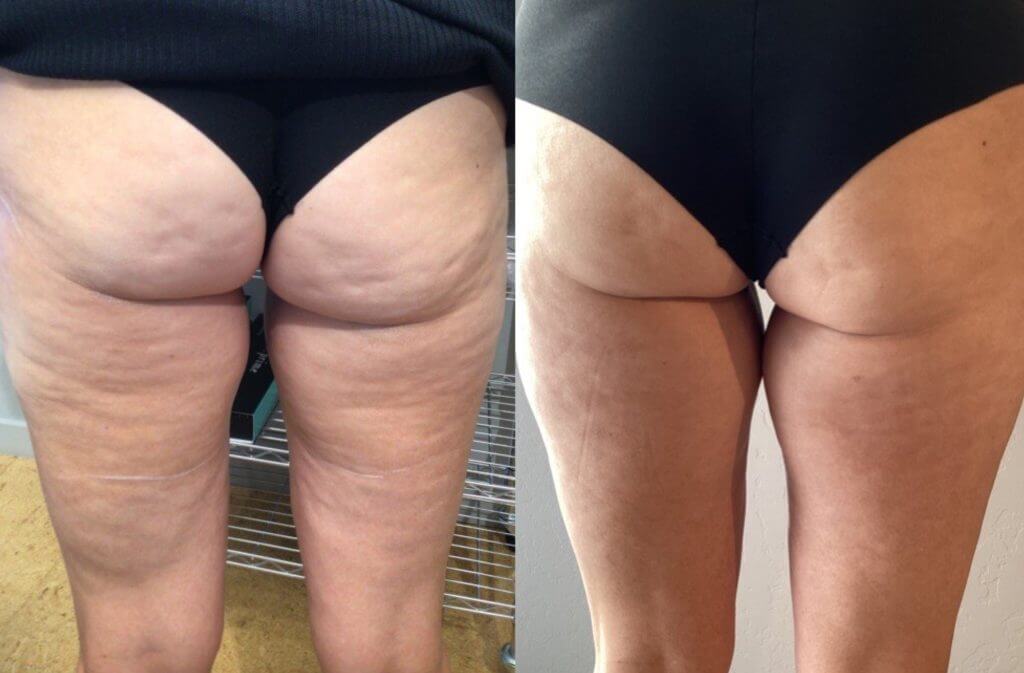 morpheus8 results by dr. melinda menezes md. photo show significant reduction in cellulite and lines on the thighs and buttocks