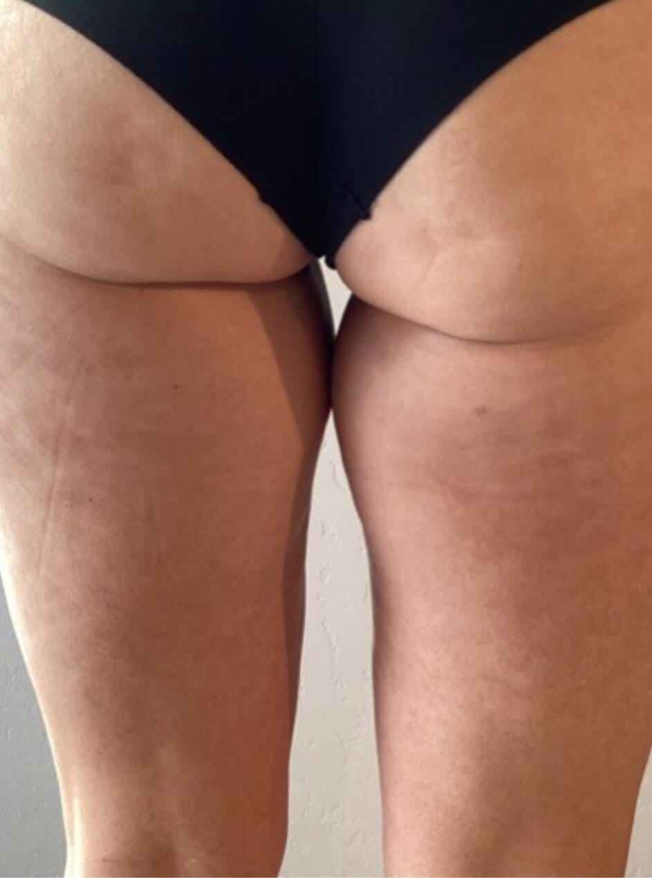 buttocks and thigh after morpheus8 treatment