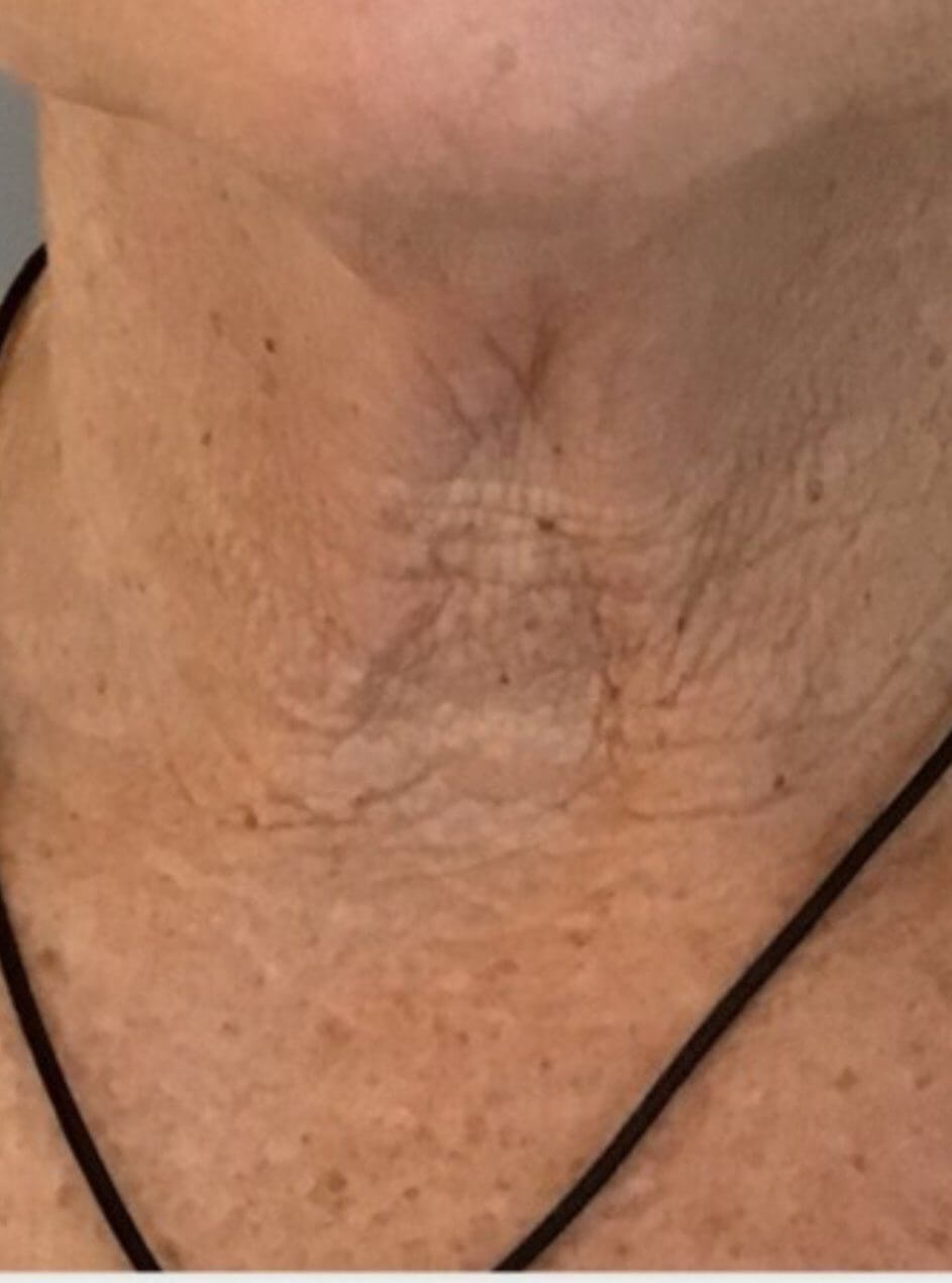 aging skin on neck before Radiesse treatment MMMD