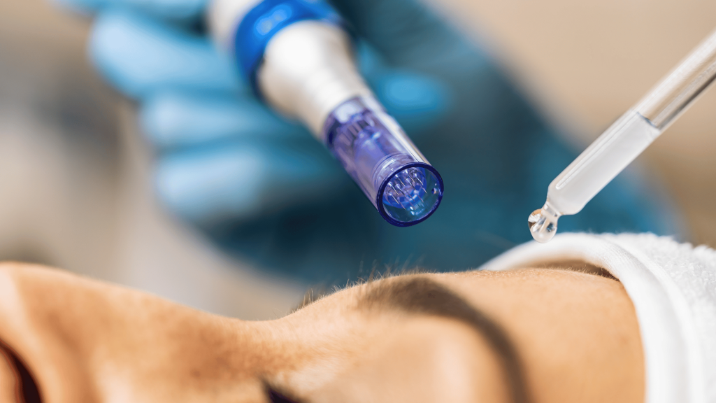 a close up image of a microneedling device. The tiny needles are visible inside the pen like device