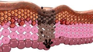 illustration of the layers of skin depicting hyperpigmentation or unwanted pigment.