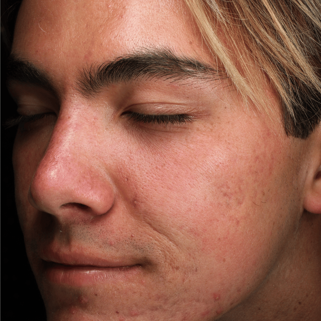 microneedle patient after treatment with significantly reduced scaring