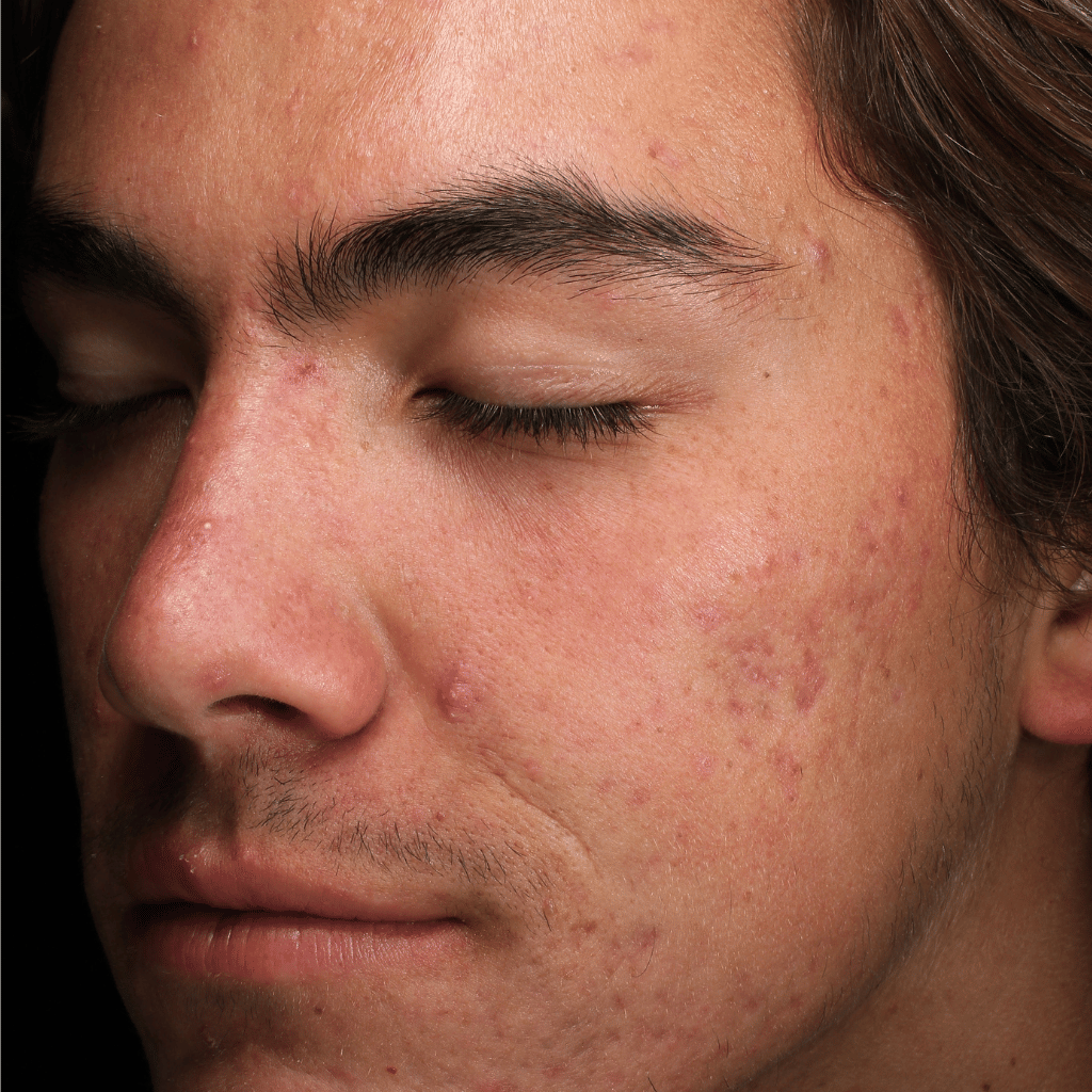 microneedle patient before treatment