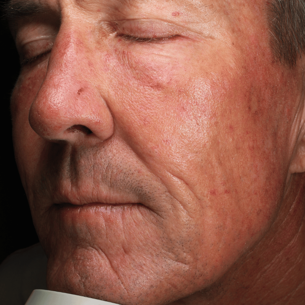 mmmd patient before glass skin facial