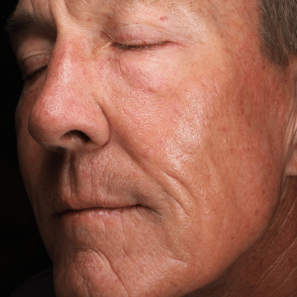 MMMD patient after glass skin facial