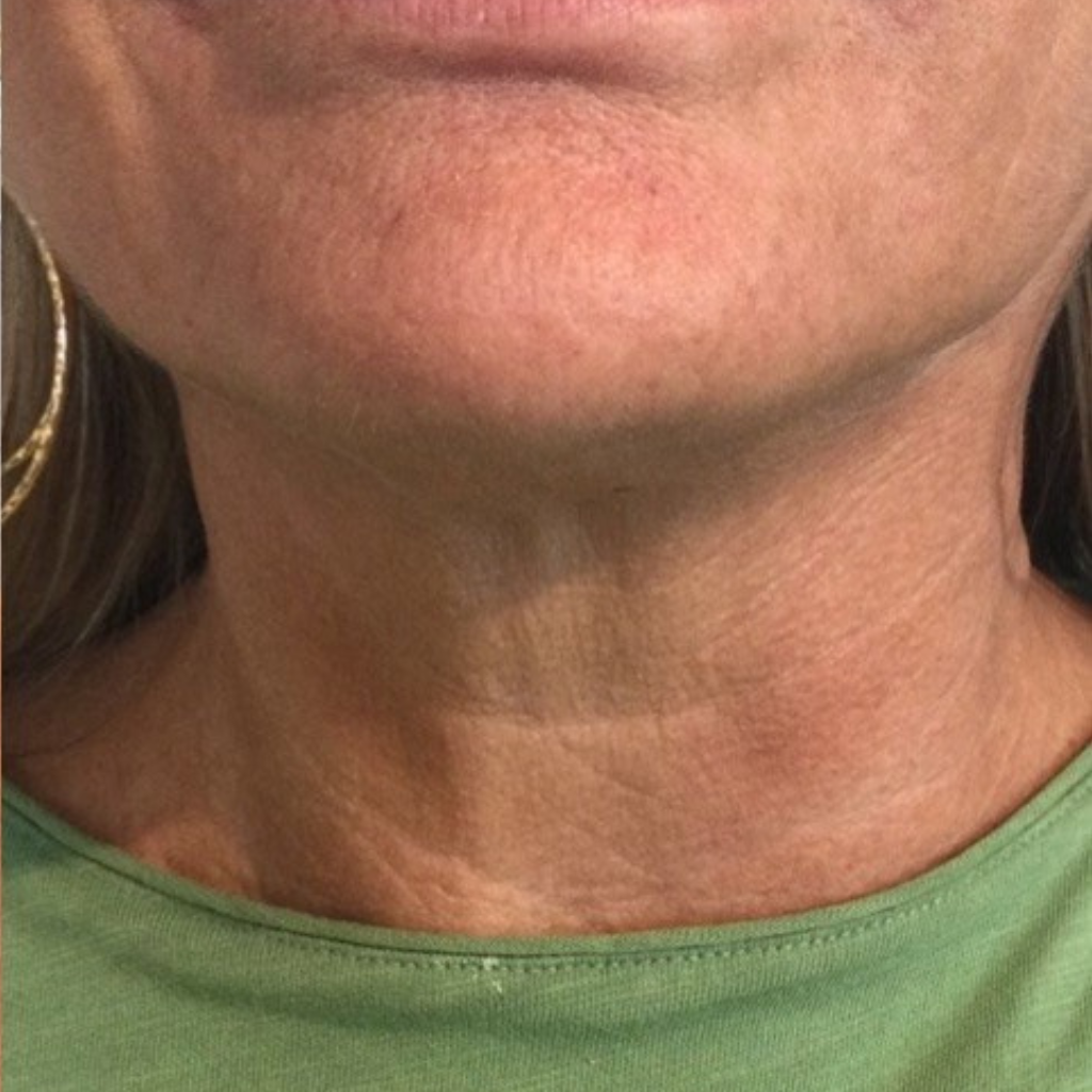 mmmd patient after morpheus8 treatment on the neck