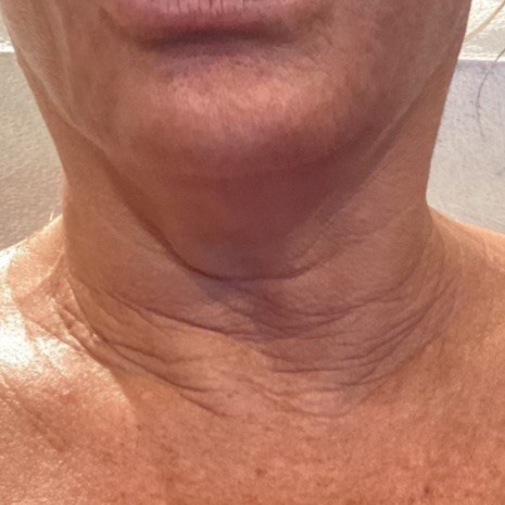 Melinda Menezes md patient before morpheus8 treatment on the neck
