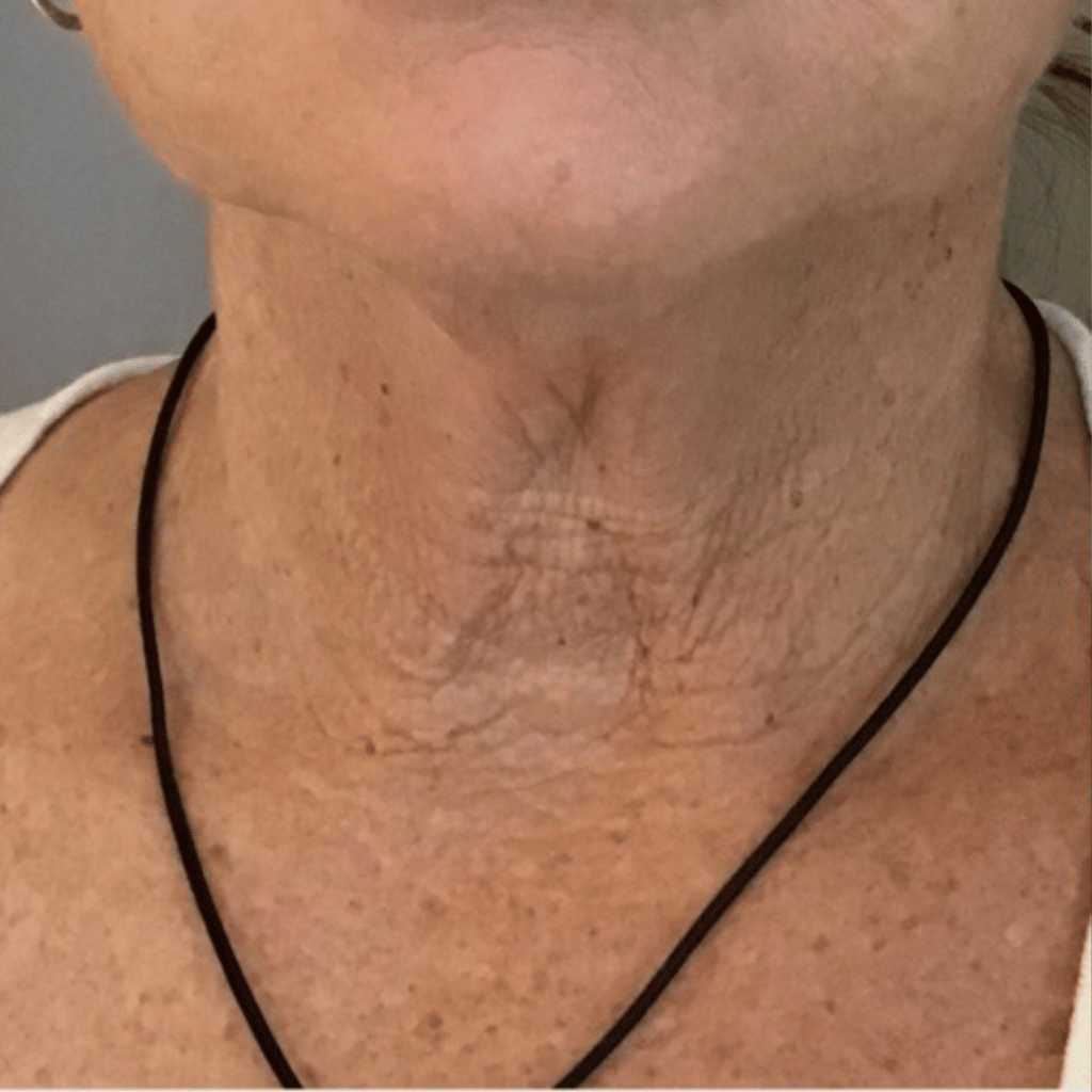 neck patient before radiesse
