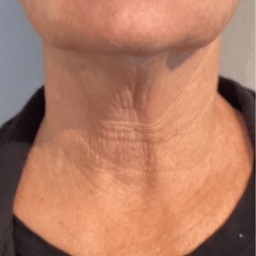 patient neck after radiesse