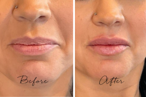 Personalized treatment at melinda menezes MD. natural looking, full and soft lip filler by Melinda Menezes MD