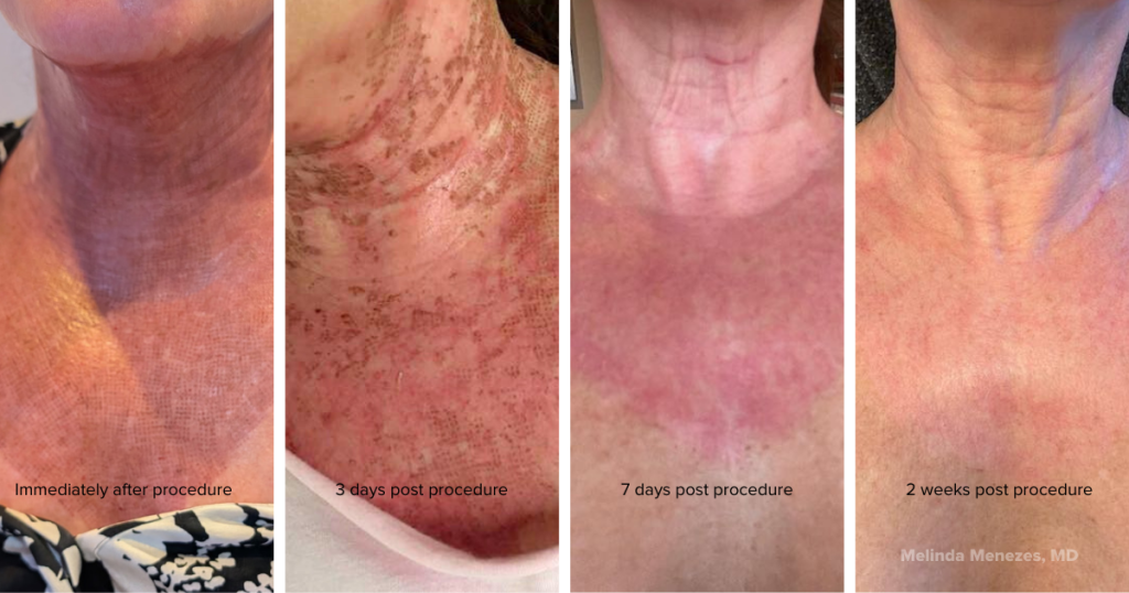 healing progression with Ariessence. Post procedure skin is red and scabbed. 7 days and two weeks post procedure skin is baby soft and refreshed.