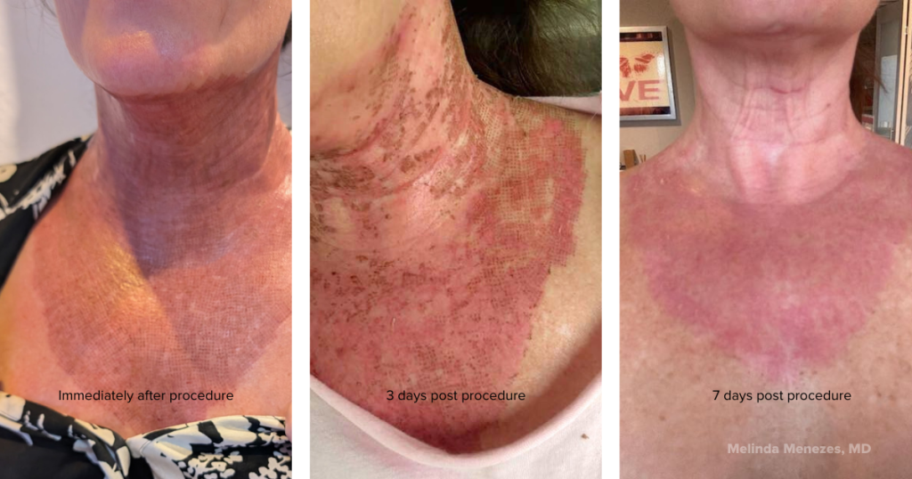 C)2 laser treatment to the neck healing progression. Day of procedure skin is deep red. 3 days after scabbing and new skin, day 7, light redness with soft skin.