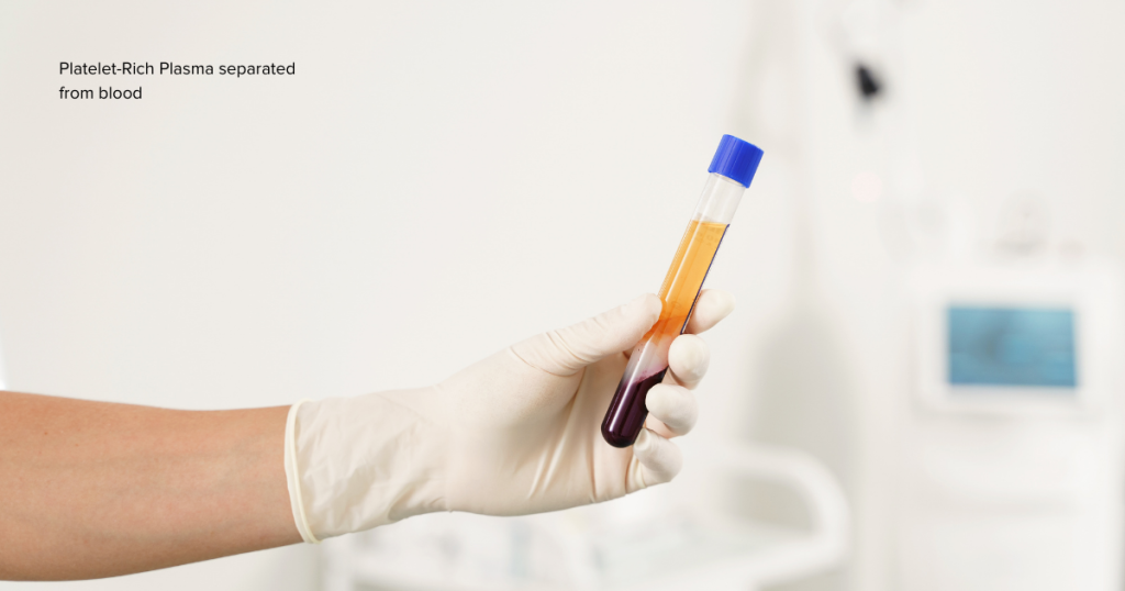 a hand holds a vial of PRP serum separated from blood.