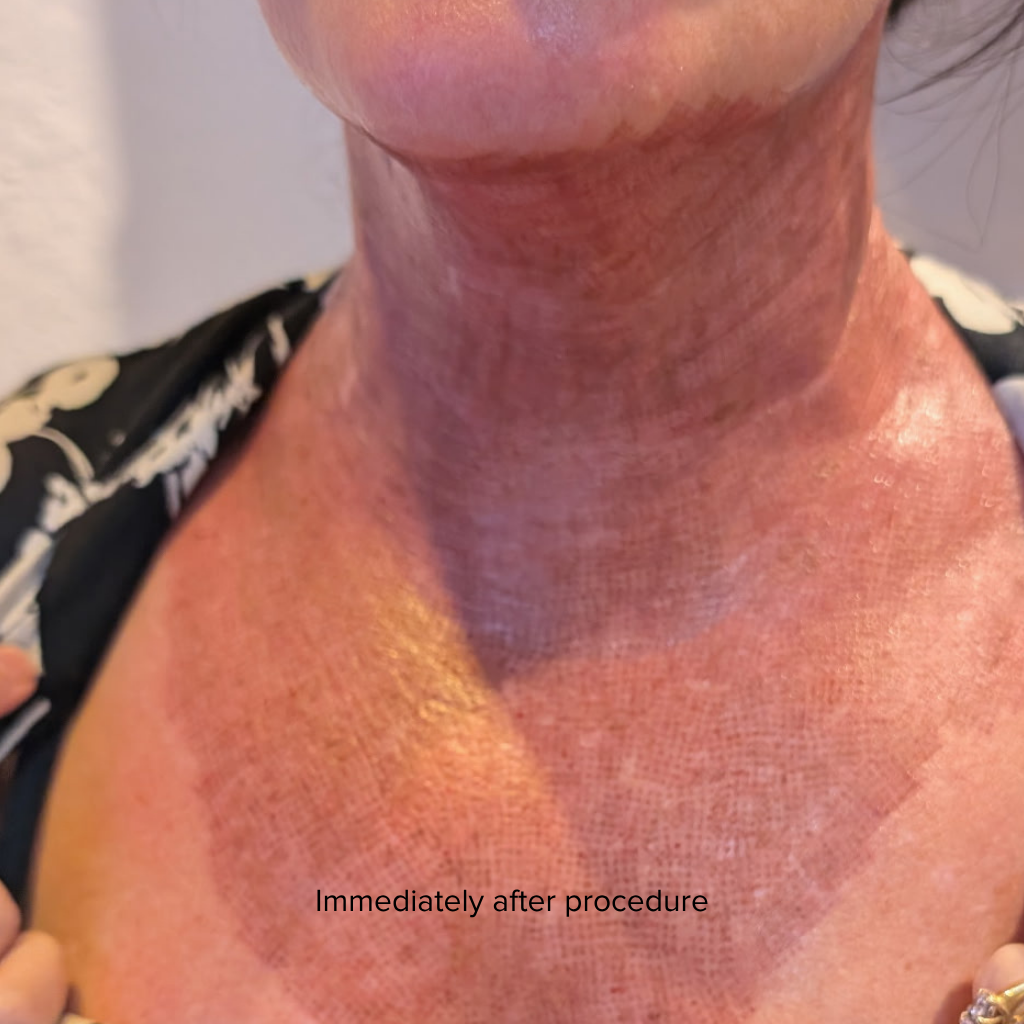 patient neck immediately after laser. The skin is red and textured.