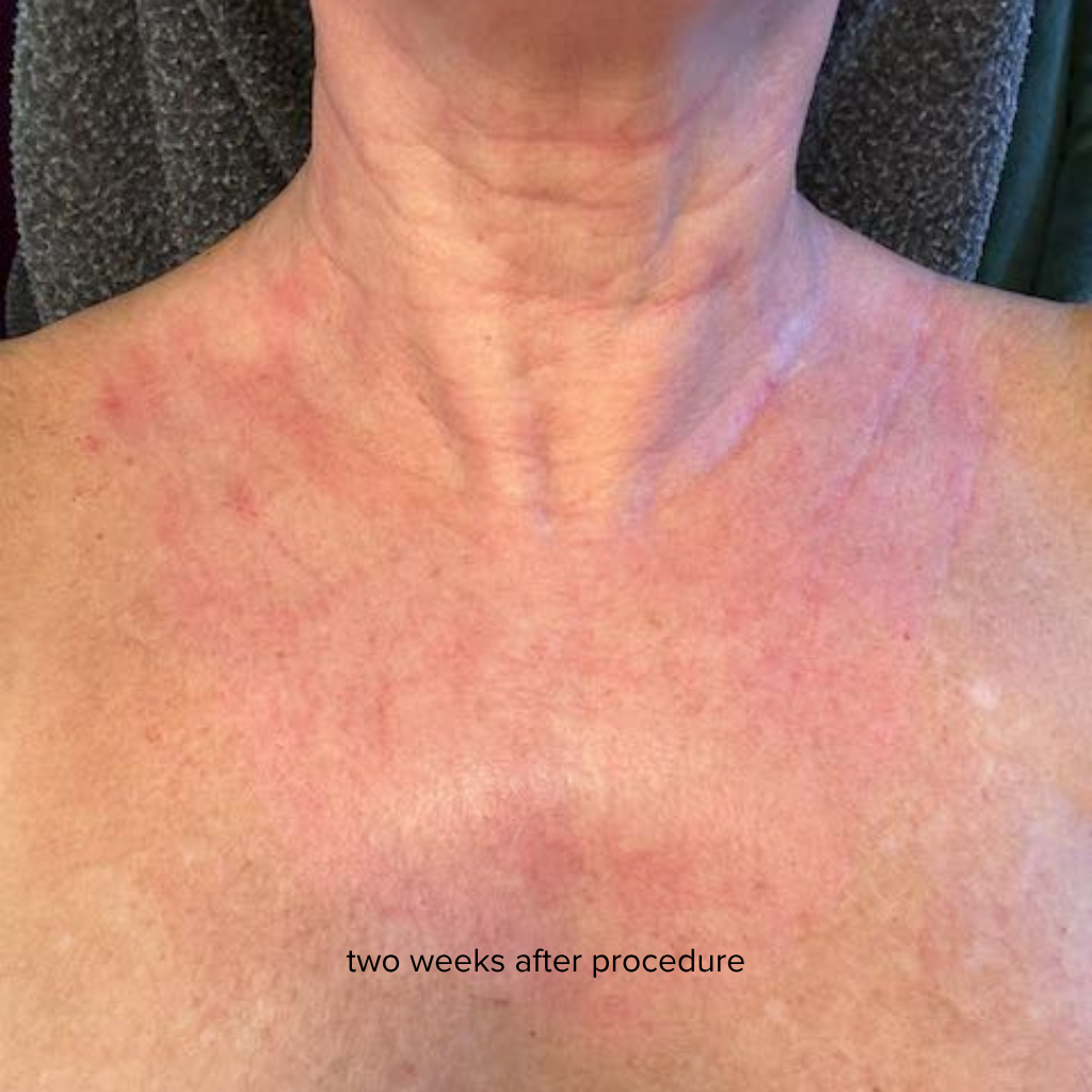patient neck 2 weeks after treatment. Skin is soft and rejuvenated.