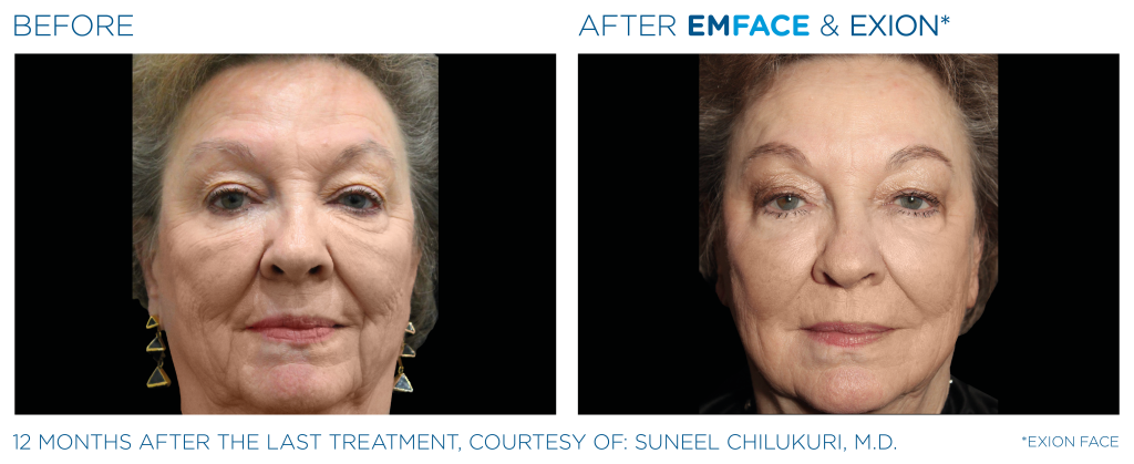 a patient before and after emface and exion treatment. skin is bright and lifted in the after photo.