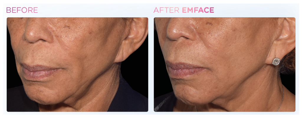 Before and after image of a patient treated with emface. In the after image cheeks are noticeably more plump and youthful.