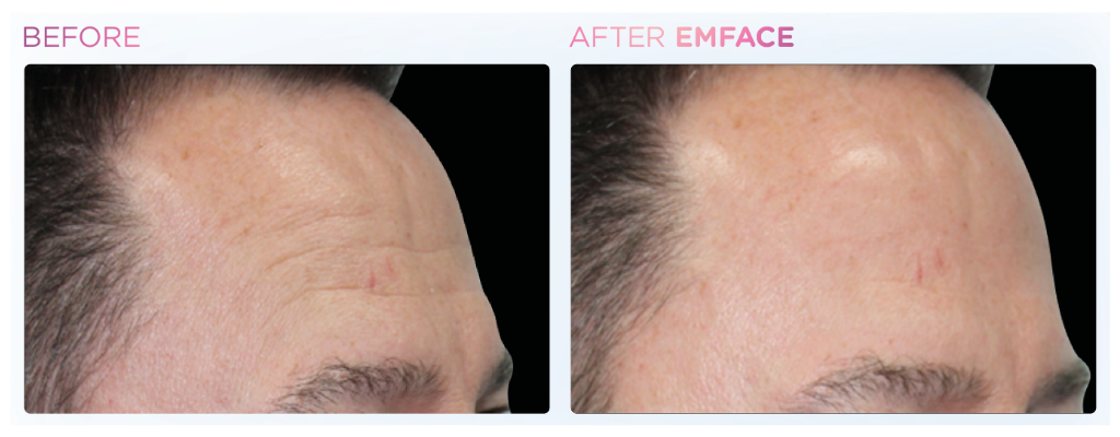 before and after images of a patient's forehead after treatment with emface.
