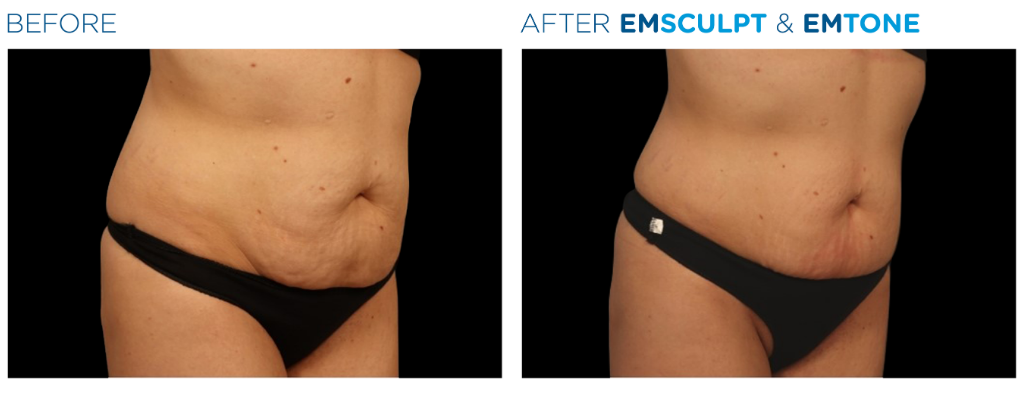 before and after of a patient's abdomen treated with emsculpt. The after image skin is noticeably tighter and firm.