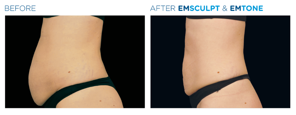 before and after image of a patient's abdominal area.