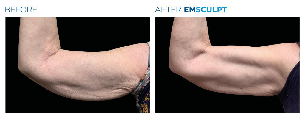 before and after image of a patient's arm after treatment with emsculpt. In the after picture skin is taut and toned.