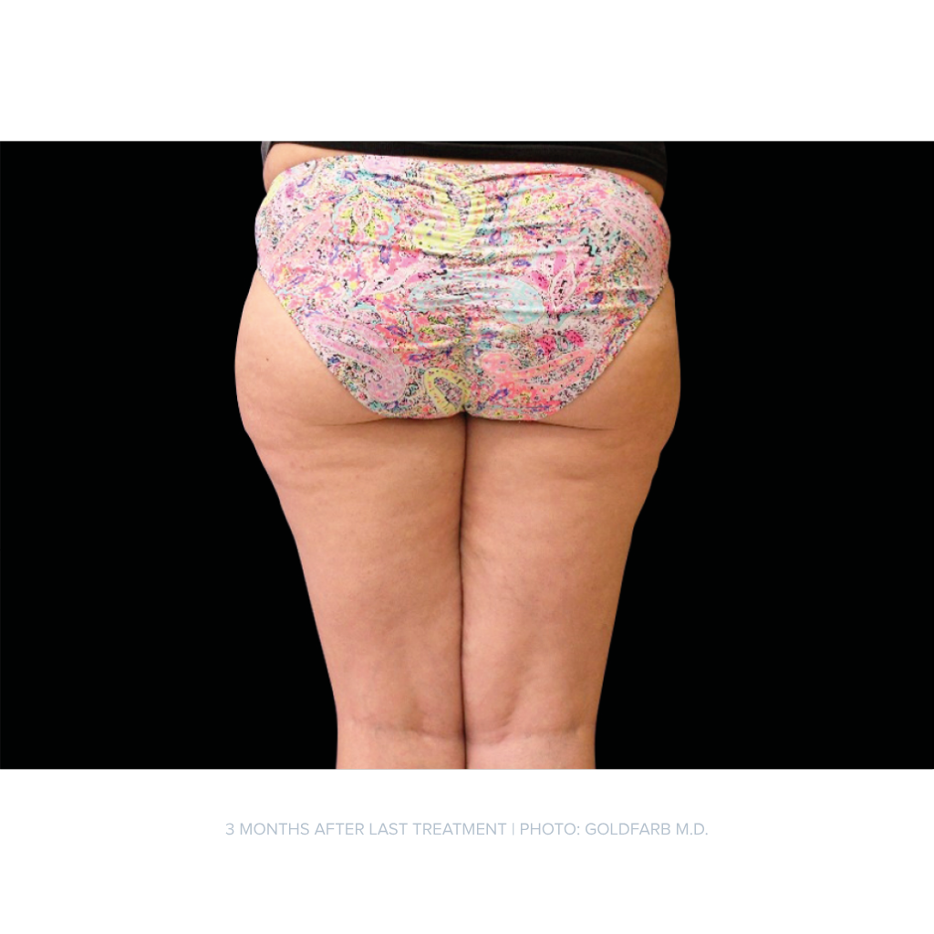 3 months after the last emsculpt treatment. Buttocks has noticeable increase in definition and lift as well as decreased cellulite.