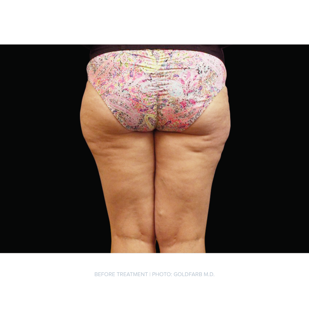before image of a female glute and buttocks