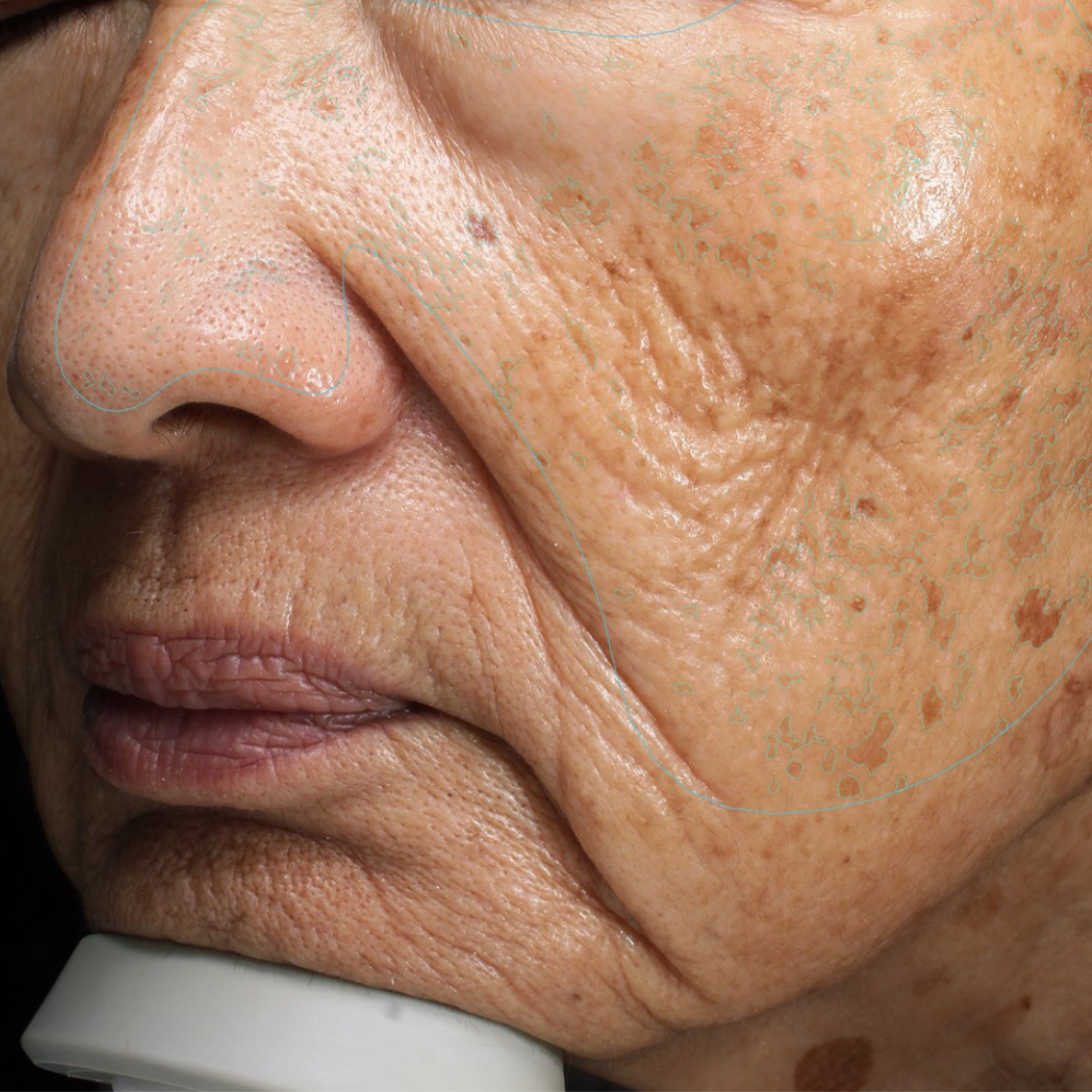 before melasma treatment. Prominent discoloration.