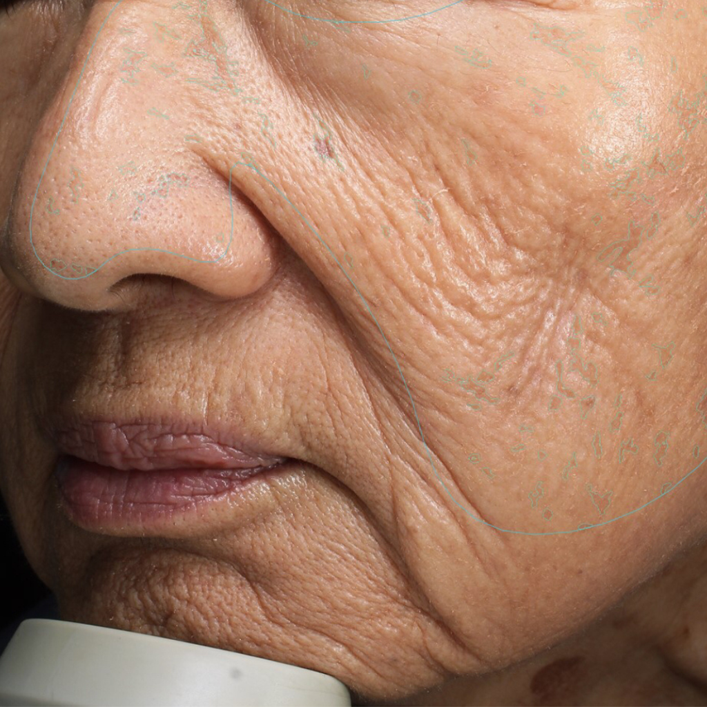 after treatment. significant reduction in spots and wrinkles.